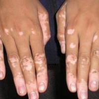 vitiligo_1_0.jpg