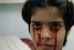 Американские врачи занялись изучением кровавого пота индийской девочки
